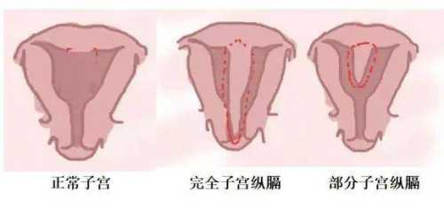 纵隔子宫流产后啥状况-第1张图片