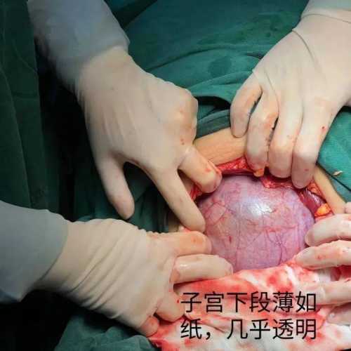 剖腹产产后大出血个案是啥样-第1张图片