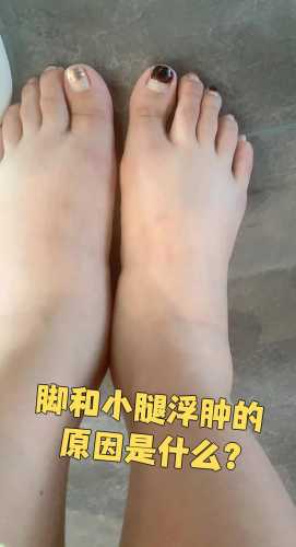 产后脚浮肿怎么办-第1张图片