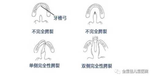 腭裂宝宝辅食怎么添加-第1张图片