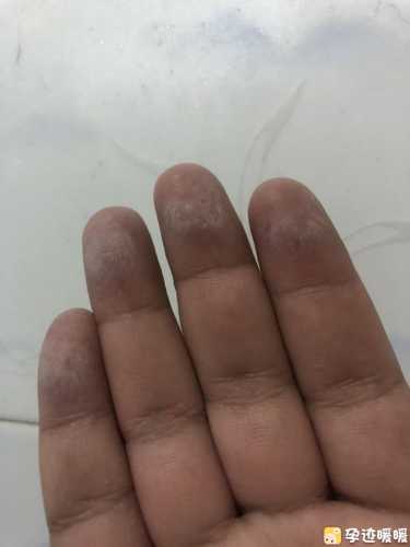 剖腹产播种网如何选择-第1张图片