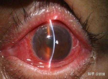 产后青光眼有哪些症状表现-第1张图片