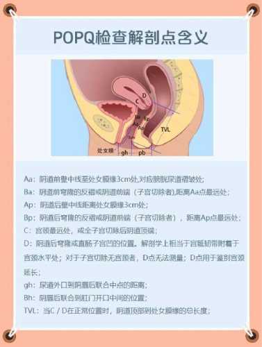 顺产后阴壁膨出有啥症状-第1张图片