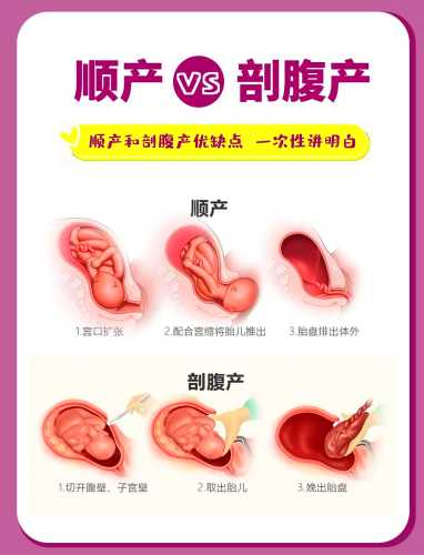 剖腹产和顺产究竟哪个好-第1张图片
