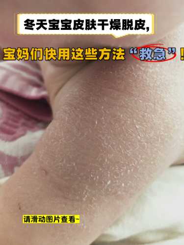 婴儿头上脱皮是怎么回事-第1张图片