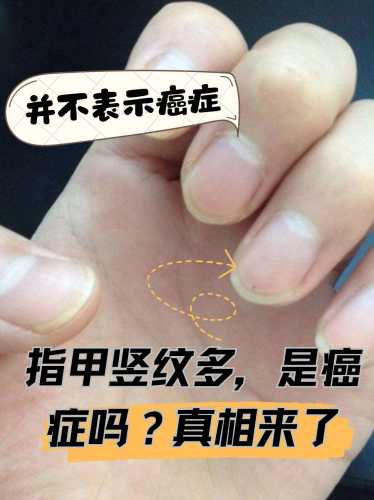 婴儿指甲出现竖纹是怎么回事-第1张图片