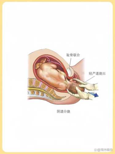 产后阴壁膨出有照片吗-第1张图片