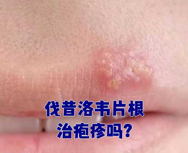 备孕期间能吃盐酸伐昔洛韦片吗-第1张图片