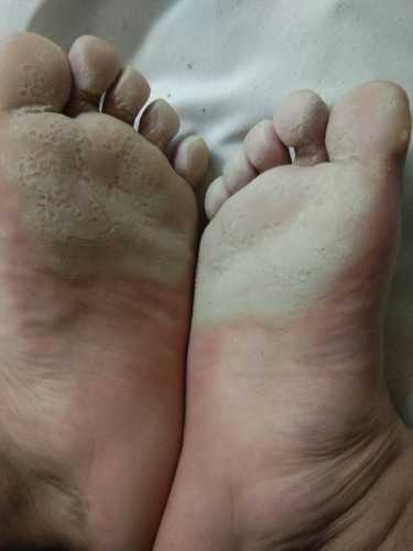 婴儿脚不平怎么办-第1张图片