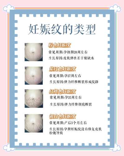 怀孕没长纹产后还会长吗-第1张图片