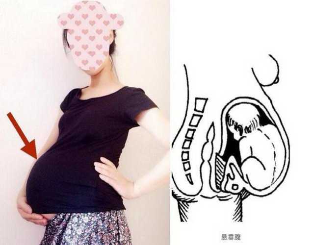 剖腹产屁股麻木如何办-第1张图片