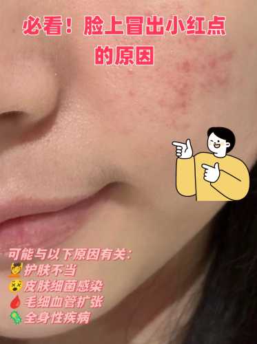顺产后脸上出现出血点咋回事-第1张图片