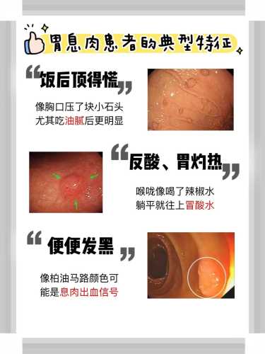 做完胃息肉多久能备孕-第1张图片