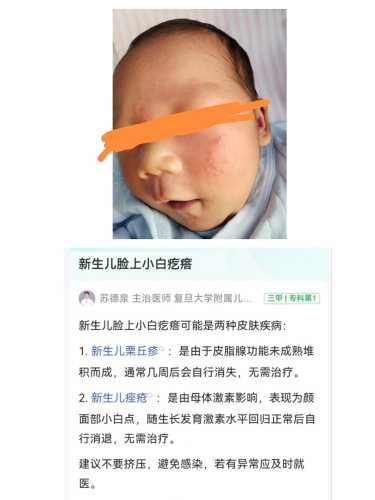 新生儿痤疮是怎么引起的-第1张图片