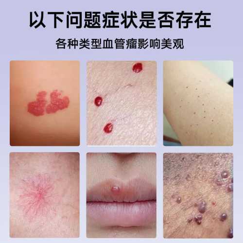 婴儿嘴唇血管瘤怎么办-第1张图片