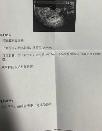 喝酒后怀孕会有影响吗-第1张图片