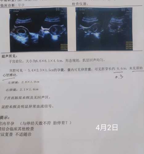 流血孕反消失是胎停吗-第1张图片