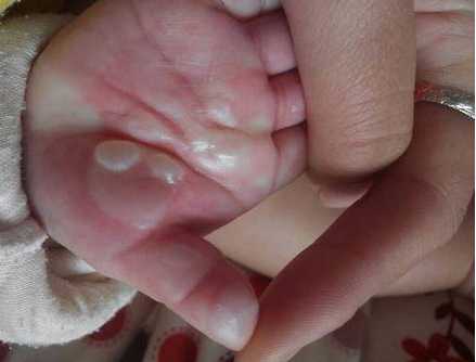 婴儿皮肤破皮如何快速处理-第1张图片