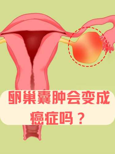 双侧卵巢囊肿影响怀孕吗-第1张图片