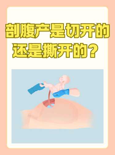 剖腹产为什么按压肚子-第1张图片