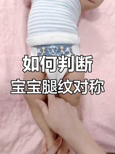 婴儿腿型不正常怎么办-第1张图片