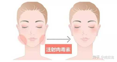 打完瘦脸针多久备孕才有效-第1张图片